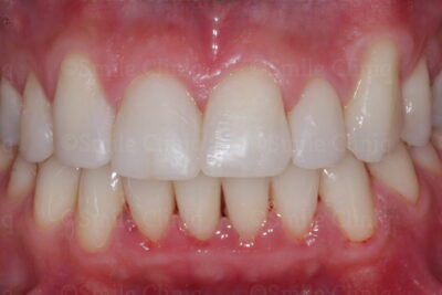 bioclear composite makeover after