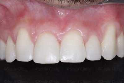teeth triangle triangles between fix