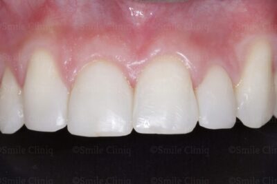 bioclear composite makeover after