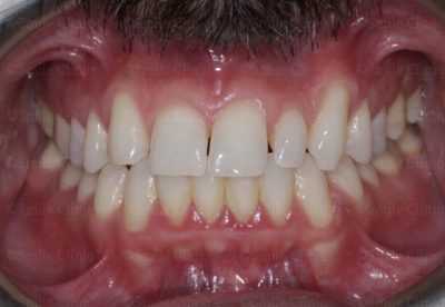 bioclear composite makeover before