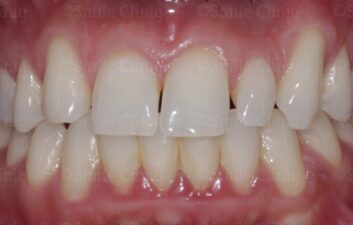 bioclear composite makeover before