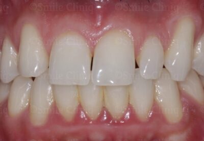 bioclear composite makeover before