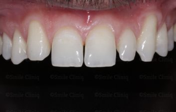 bioclear composite makeover before
