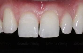 bioclear composite makeover before