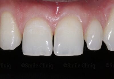 bioclear composite makeover before