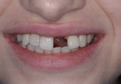 Before emergency bridge treatment