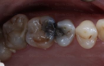 multiple amalgam removal before