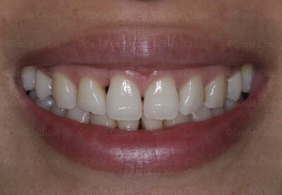 multiple bioclear before