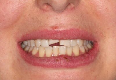 Fractured incisor before treatment