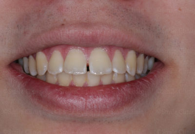 gaps in teeth before