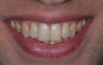 edge bonding incisor after