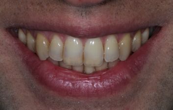 edge bonding incisor before