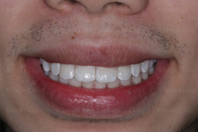 gaps in teeth after