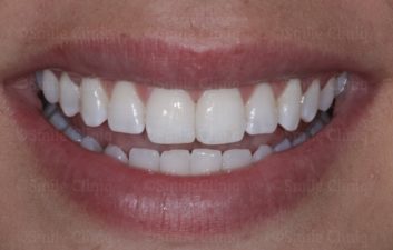 incisor midline bonding after