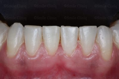 lower incisal crowding after