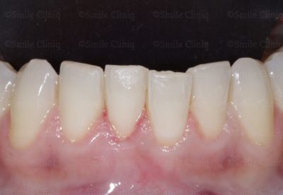 lower incisal crowding before