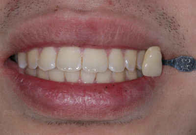 yellow teeth London before