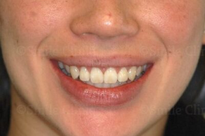 Invisalign London After