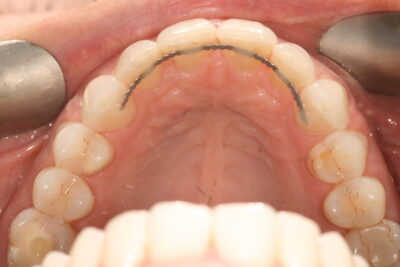 Invisalign Braces Before