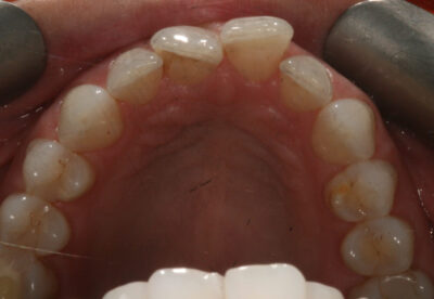 Invisalign Braces Before