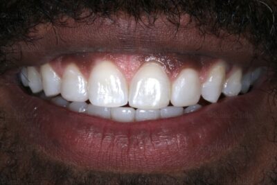 after invisalign and bonding london dentist