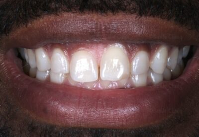 before invisalign and bonding london dentist