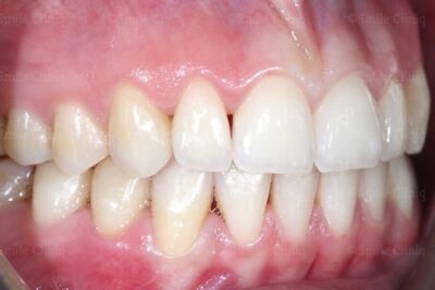 Invisalign Treatment after