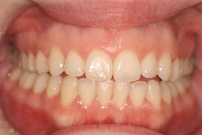 London dentist invisalign after 