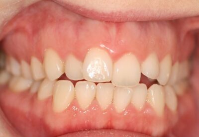 London dentist invisalign before