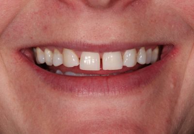 Mini Smile Makeover London before 
