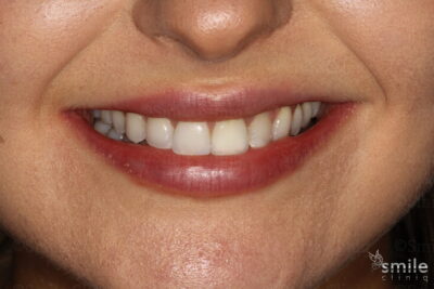 Smile makeover london dentist after