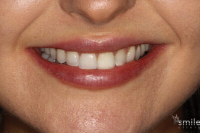Smile makeover london dentist after
