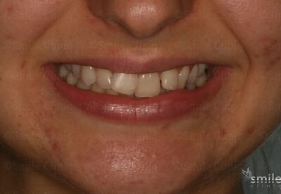 Smile makeover london dentist before
