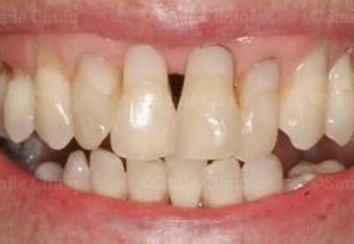 Gingival veneer London Dentist before