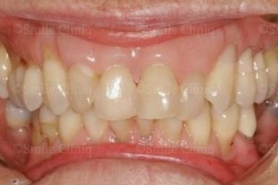 Gingival veneer London Dentist after