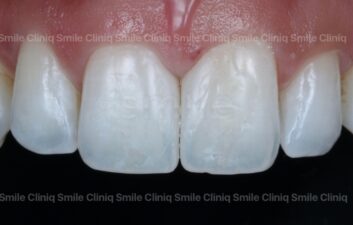 Black triangles smile cliniq london After