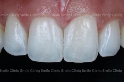 Black triangles smile cliniq london After