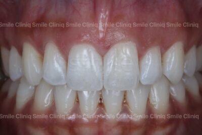 Black triangles smile cliniq london After