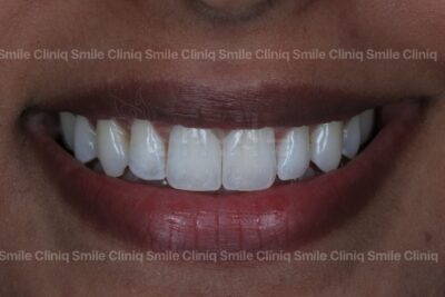 Black triangles smile cliniq london After