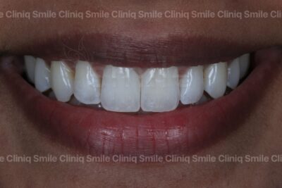 Black triangles smile cliniq london After