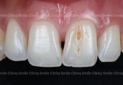 Black triangles smile cliniq london Before