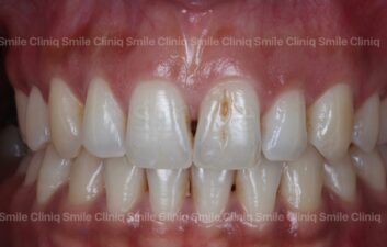 Black triangles smile cliniq london Before