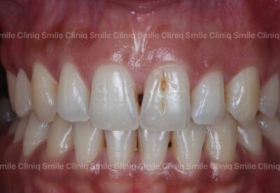  Black triangles smile cliniq london Before