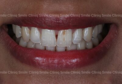 Black triangles smile cliniq london Before