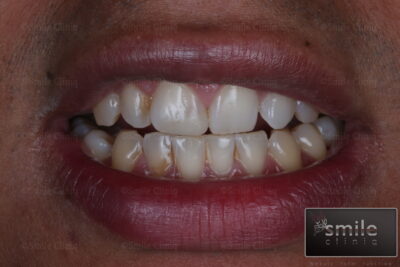 broken front tooth filling after