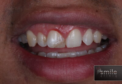 broken front tooth filling before