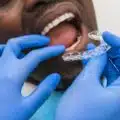 will invisalign work for me? thumbnail
