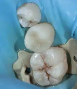 composite dental fillings