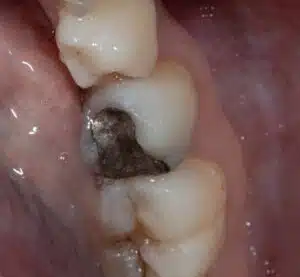 Amalgam Filling
