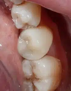Natural Composite Restoration